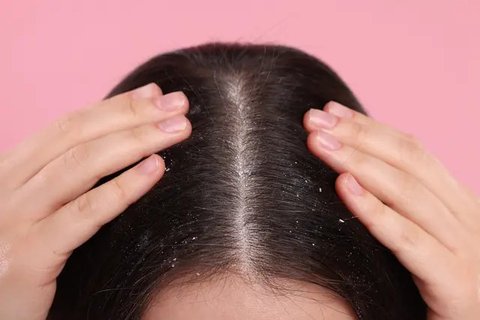 Rekomendasi sampo anti ketombe (everydayhealth.com)