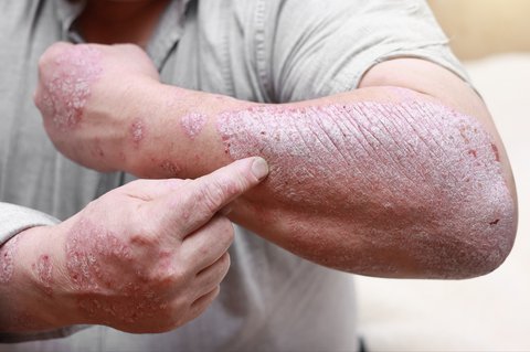 Inovasi Klinik Kecantikan Hadirkan Treatment Psoriasis untuk Keluarga, Cek Fakta Penyakit Ini Yuk!