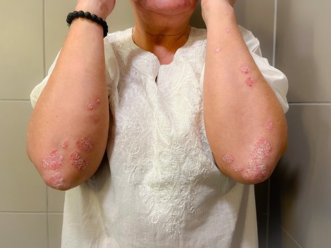 Inovasi Klinik Kecantikan Hadirkan Treatment Psoriasis untuk Keluarga, Cek Fakta Penyakit Ini Yuk!