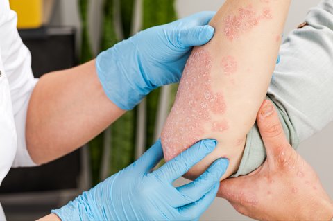 Inovasi Klinik Kecantikan Hadirkan Treatment Psoriasis untuk Keluarga, Cek Fakta Penyakit Ini Yuk!