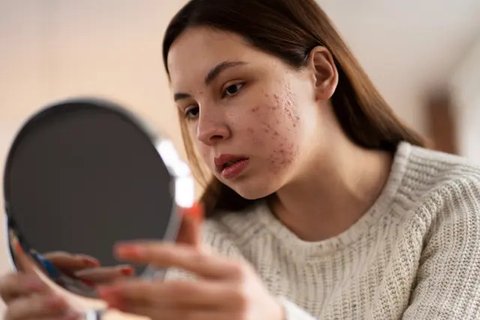 Jerawat di pipi sulit hilang. (Foto: Unsplash/Barbara Krystofiak)