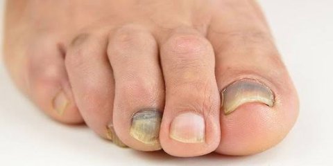 Mencegah Kuku Kuning dan Rapuh: Tips Perawatan yang Harus DiketahuiKuku Sehat Tanpa Kuning: Strategi dan Perawatan untuk Kuku yang Kuat