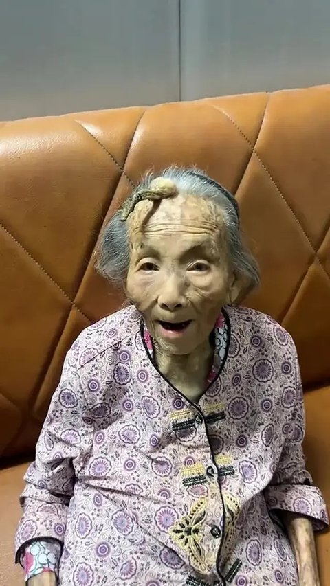 Dahi Nenek 107 Tahun Ini Tumbuh Tanduk (Sumber:Douyin via New York Post)