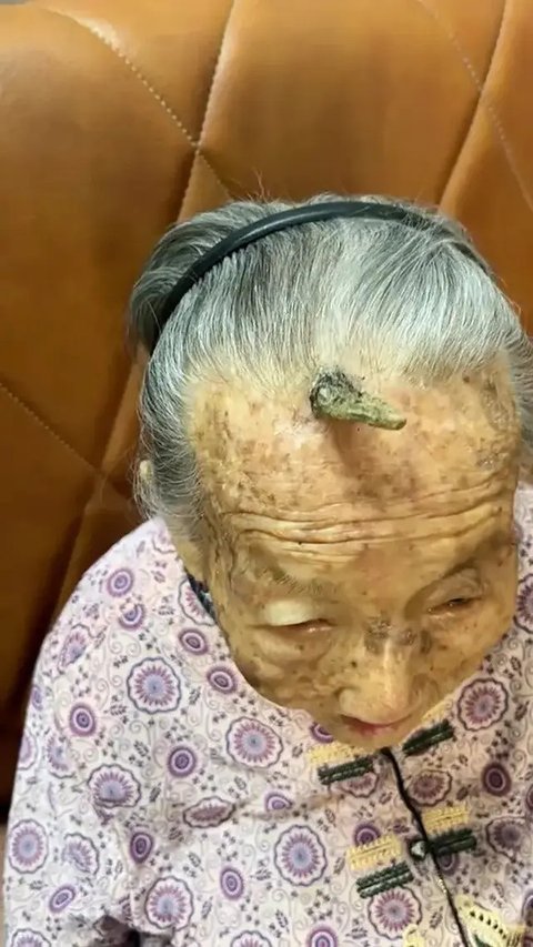 Dahi Nenek 107 Tahun Ini Tumbuh Tanduk (Sumber:Douyin via New York Post)