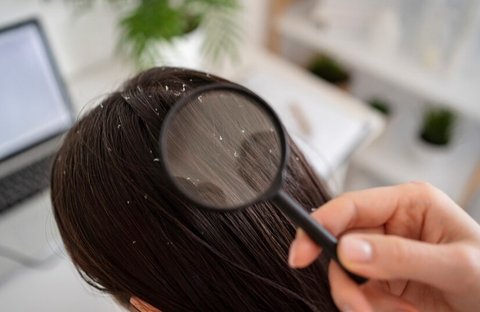 Cara Menghilangkan Ketombe Kering dan Basah