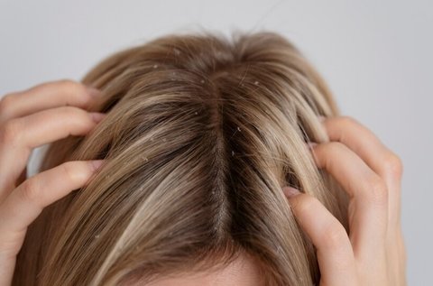 Cara Menghilangkan Ketombe Kering dan Basah