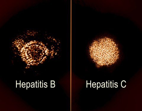hepatitis b dan c