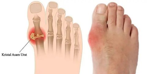 cara menurunkan asam urat (foto: Pixabay)