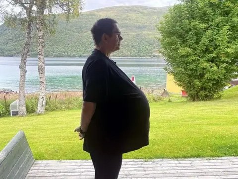 Pria Jerman Punya Tumor Seberat 27 Kg di Perut (Sumber: NF/newsX via NYP)