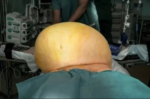 Pria Jerman Punya Tumor Seberat 27 Kg di Perut (Sumber: NF/newsX via NYP)
