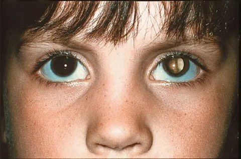Ilustrasi. (foto: Pinterest/All About Vision).