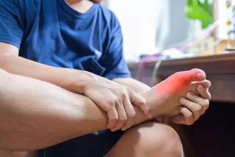 Ilustrasi sakit asam urat. (Shutterstock)