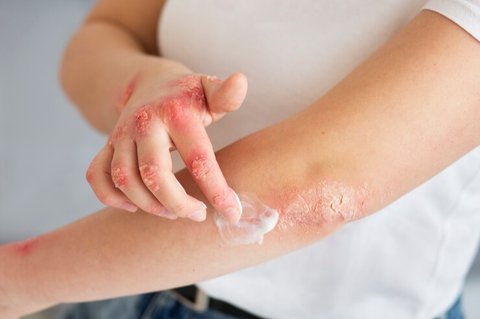 eczema