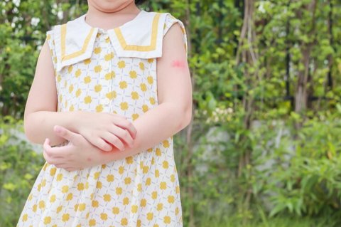 Biduran (Hives atau Urtikaria)