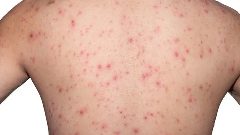 Ruam Panas (Heat Rash)