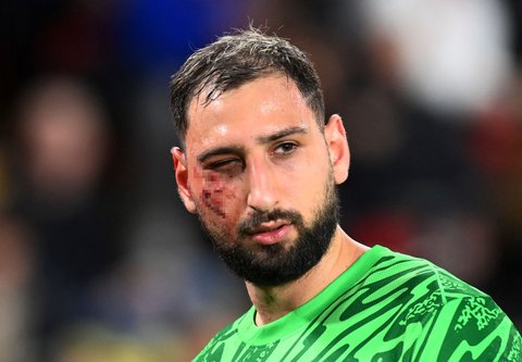 FOTO: Ngeri! Begini Kondisi Wajah Donnarumma Berdarah-darah Usai Tendangan Horor Wilfried Singo