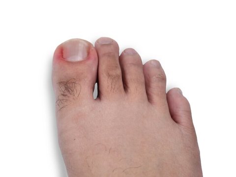 Penyebab Kuku Kaki Tumbuh ke Dalam