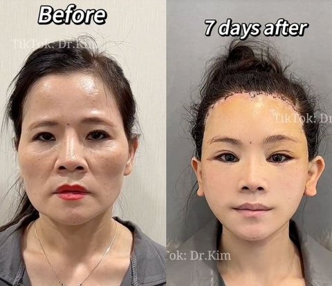 Potret Transformasi Kontroversial  Pasien Dr. Kim,  Spesialis Bedah Plastik yang Viral di TikTok