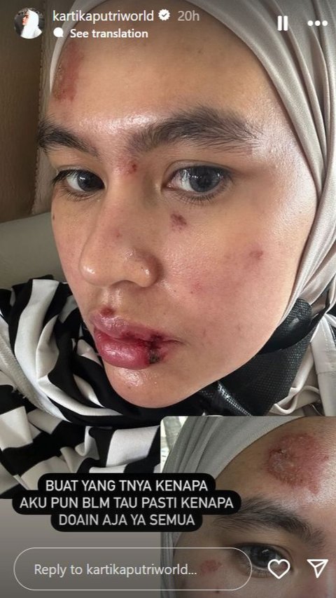 Kartika Putri Attacked by Mysterious Disease, Face Covered in Blisters and Tongue with Large Canker Sores