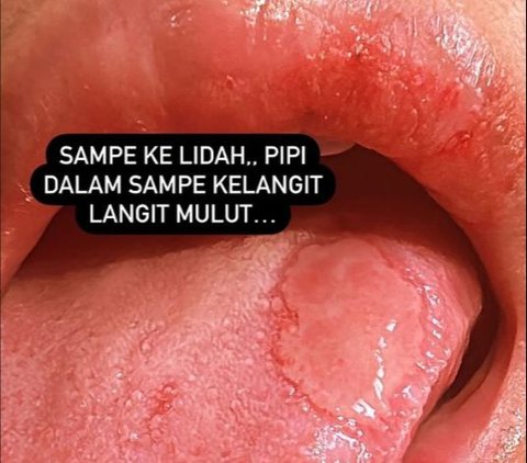 Kartika Putri Attacked by Mysterious Disease, Face Covered in Blisters and Tongue with Large Canker Sores