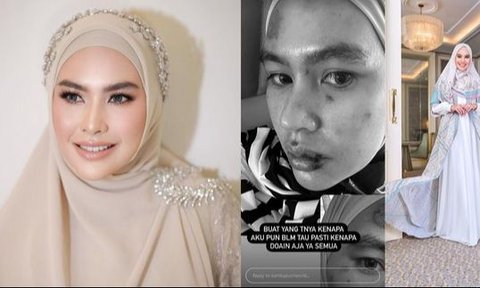 Kartika Putri Sakit Misterius, Wajah dan Lidahnya Melepuh! Berikut Kabarnya