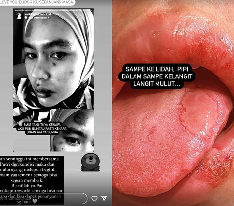 6 Artists Suffer from Mysterious Illness, Latest Kartika Putri's Face & Mouth Covered in Blistering Sores