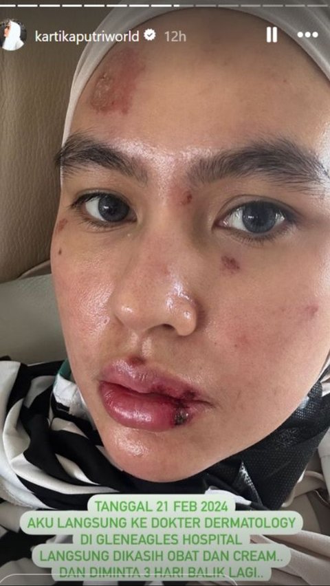 Revealed: The Cause of Kartika Putri's Blistering and Rash on Her Face