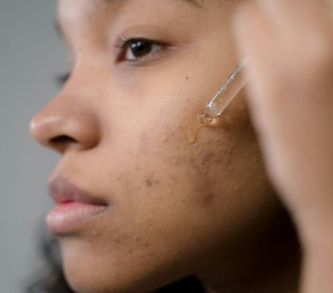 Asam Glikolat pada Skincare itu Apa Fungsinya? Benarkah Alami dan Tanpa Efek Samping?