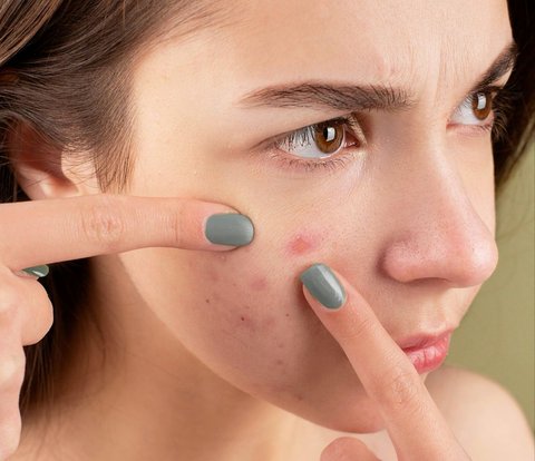 3 Makeup Dasar yang Selalu Bisa Diandalkan untuk Samarkan Jerawat