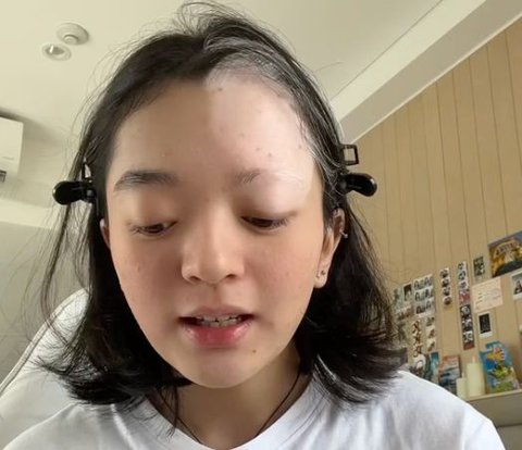 Tiktoker's Experience with Vitiligo, Suspects Hair Coloring