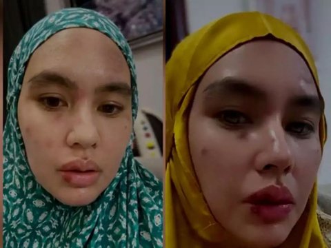 Face Blistered, Latest Portrait of Kartika Putri who Suffers from Steven Johnson Syndrome.