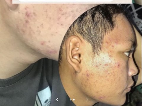 Story: Employees Asked to Wear Masks When Meeting Customers because This Acne Makes Them Uncomfortable