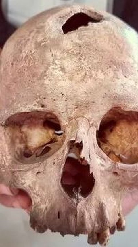 Salah satu tengkorak Zaman Perunggu memiliki lubang di tengkorak melalui metode trepanasi; individu ini tampaknya menderita beberapa penyakit, dan ini mungkin merupakan upaya penyembuhan.