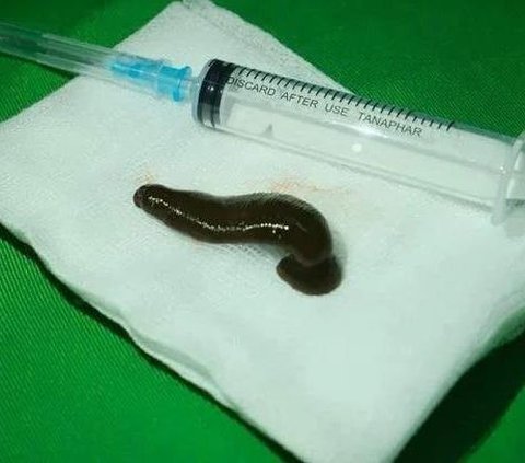 The Man's Voice Suddenly Hoarse and Vomiting Blood, Thought to be Ordinary Flu, When Examined Turns Out There is a Live Leech Stuck in the Throat