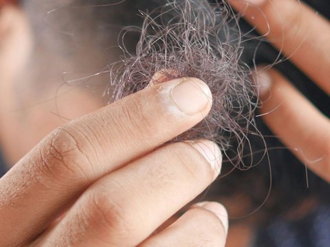 Bahan Alami untuk Menumbuhkan Rambut Botak