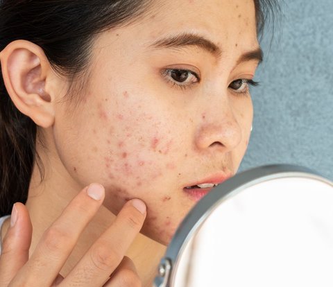 3 Bahan Aktif yang Bisa Atasi Jerawat, Pastikan Ada di Skincare Harian