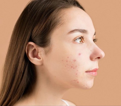 3 Active Ingredients that Can Treat Acne, Make Sure They are in Daily Skincare