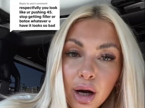 Addicted to Fillers and Botox, This Girl is Shocked That Her Skin is Wrinkled Instead, Thought to be 45 Years Old at the Age of 22