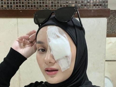 Initially Thought to be a Stye, Dinda Hauw Turns Out to Have Chalazion and Needs to be Removed, One Eye is Bandaged