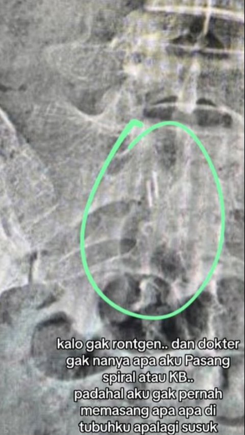 Admitting to Being Cursed, Here's the X-Ray Photo Evidence of the Strange Objects in Stevie Agnecya's Body, See the Appearance