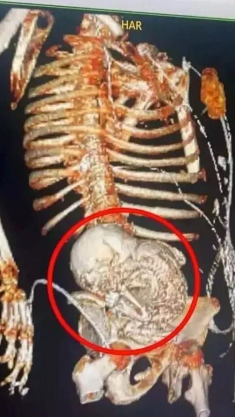 Enlarged Stomach Mistaken for Cancer, 81-Year-Old Grandmother Turns Out to be 'Pregnant' for 50 Years Until the Fetus Fossilized