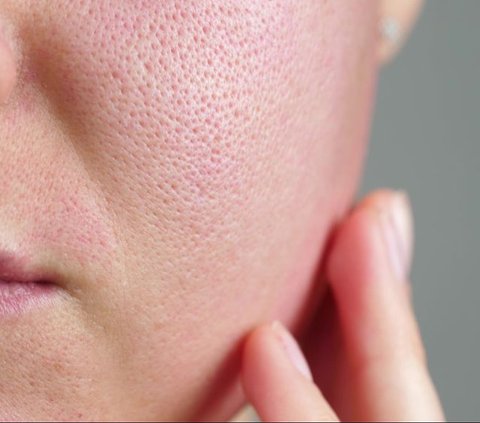 Large Pores on Dry Skin, There is a Way to Prevent it from Getting Worse