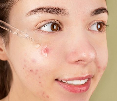 Acne Medication Causes Cancer, Is It True?