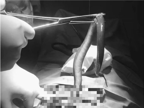 Terrifying! Extraordinary Stomach Ache Patient, Live 30 cm Eel Found Gnawing the Intestines During Surgery