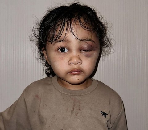 Chronology of Celebgram Aghnia Punjabi's Child Being Abused by Nanny, Face Covered in Bruises
