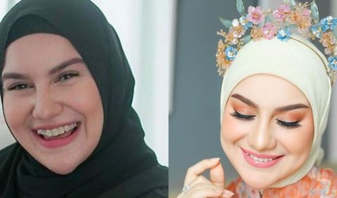 Irish Bella memilih untuk merapikan gigi gingsulnya dengan menggunakan kawat gigi atau behel demi meningkatkan kepercayaan dirinya. 