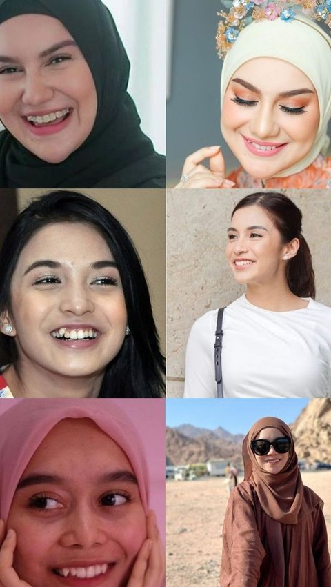 Transformasi 6 Artis Setelah Hilangkan Gigi Gingsul, Ini Potret Sebelum dan Sesudahnya