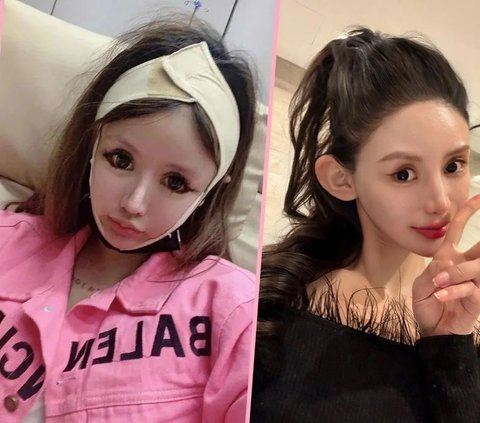 This Girl Spends Rp8.8 Billion for 100 Plastic Surgeries Since the Age of 13 to Resemble Artists, but Her Face Turns Out Like This
