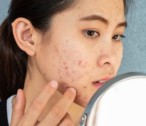 How to Conceal Textured and Red Acne with Makeup Tricks