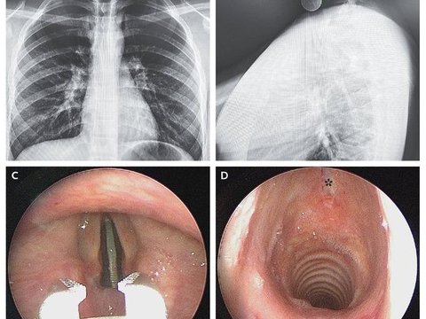 Unintentional Incident, Metal Coin Stuck in the Vocal Cord of a 14-Year-Old Teenager